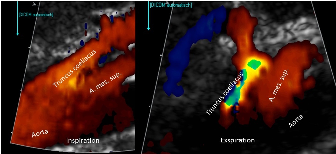 TruncuscoeliacusKompression / DunbarSyndrom / MALS / Ligamentum